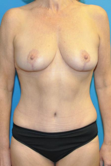 After image 1 Case #130141 - Mommy Makeover
