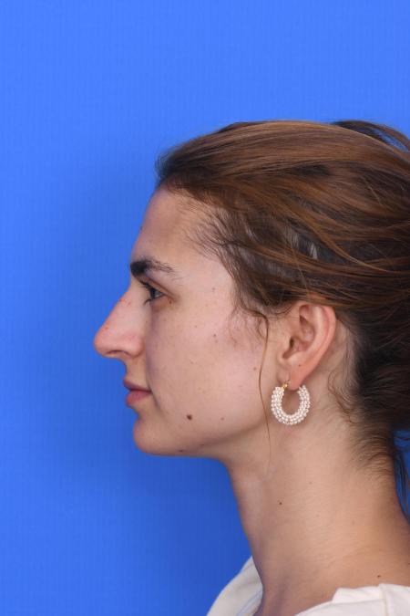 Before image 2 Case #129951 - RHINOPLASTY