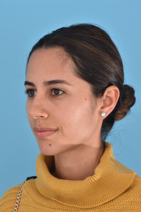 Before image 2 Case #130026 - PRIMARY RHINOPLASTY