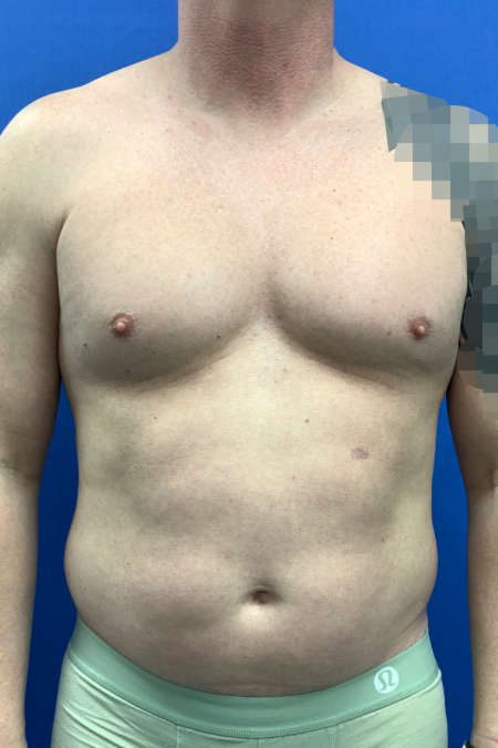 Before image 1 Case #129431 - Liposuction