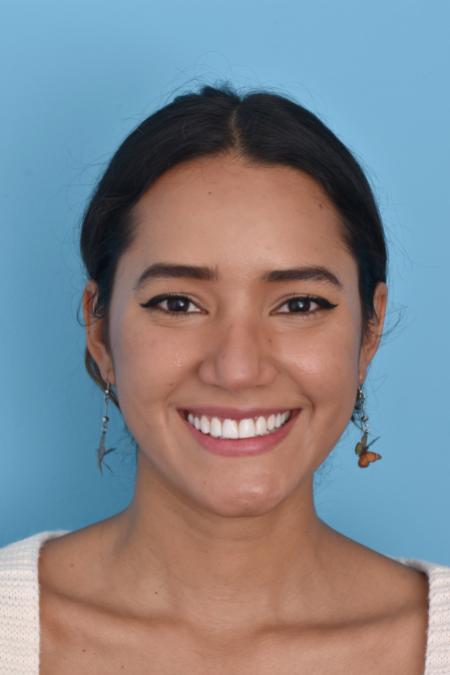 Before image 6 Case #129946 - RHINOPLASTY