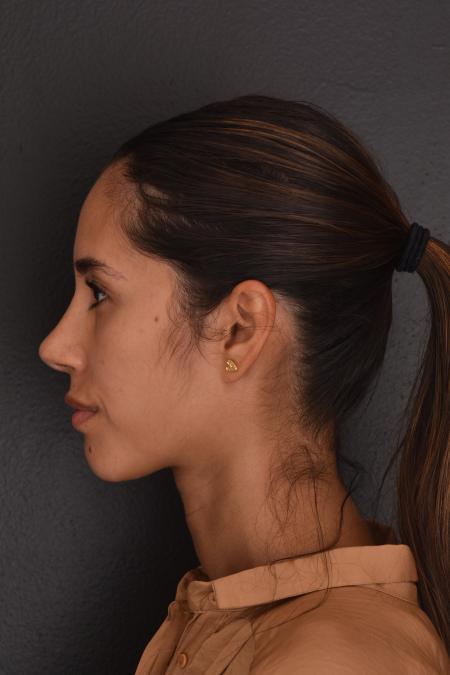 After image 3 Case #130026 - PRIMARY RHINOPLASTY