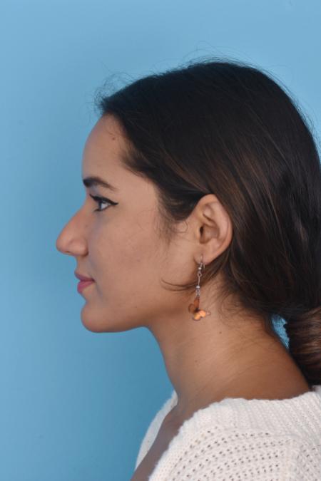 Before image 4 Case #129946 - RHINOPLASTY