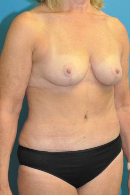 After image 2 Case #130151 - Mommy Makeover