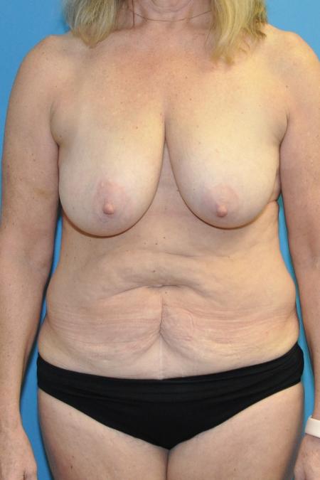 Before image 1 Case #130151 - Mommy Makeover