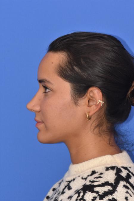 After image 4 Case #129946 - RHINOPLASTY