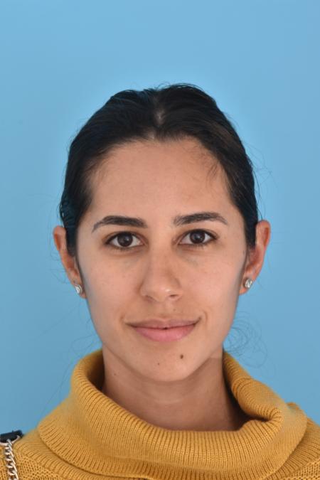 Before image 1 Case #130026 - PRIMARY RHINOPLASTY