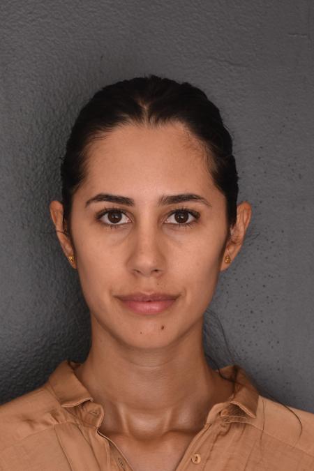 After image 1 Case #130026 - PRIMARY RHINOPLASTY