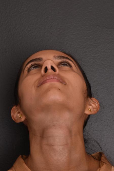 After image 5 Case #130026 - PRIMARY RHINOPLASTY