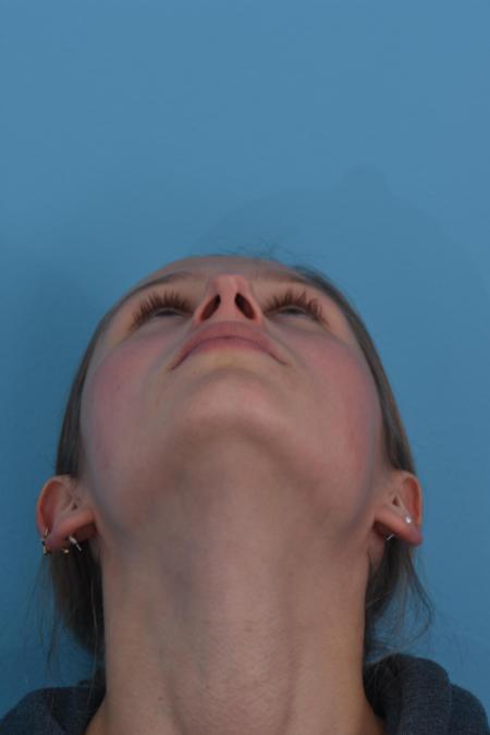 Before image 6 Case #130261 - STRUCTURAL RHINOPLASTY