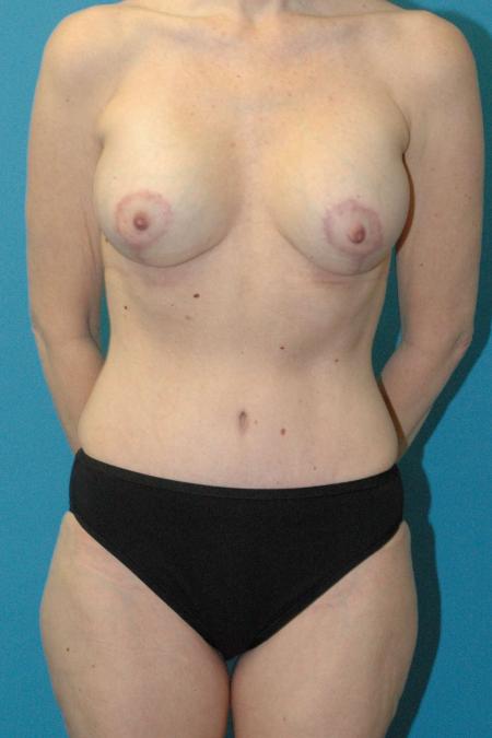 After image 1 Case #130381 - Mommy Makeover