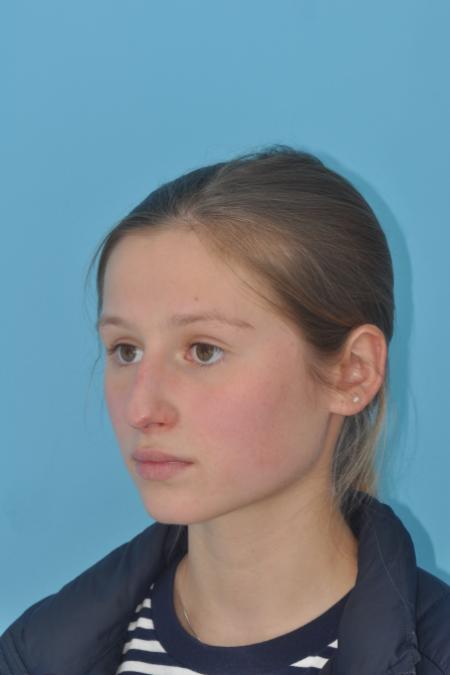 Before image 4 Case #130261 - STRUCTURAL RHINOPLASTY
