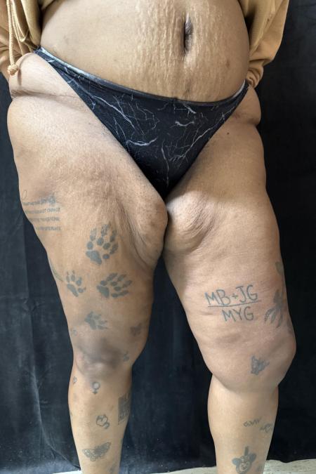 Before image 3 Case #130396 - Thigh Lift