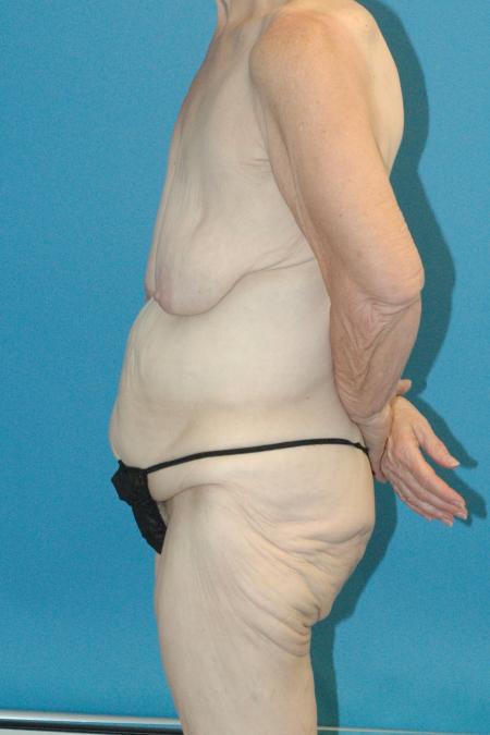 Before image 3 Case #130326 - Post Weight Loss Body and Breast Surgery