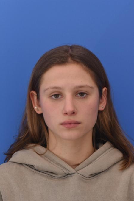 After image 1 Case #130261 - STRUCTURAL RHINOPLASTY