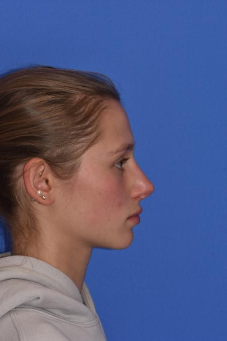 After image 5 Case #130261 - STRUCTURAL RHINOPLASTY