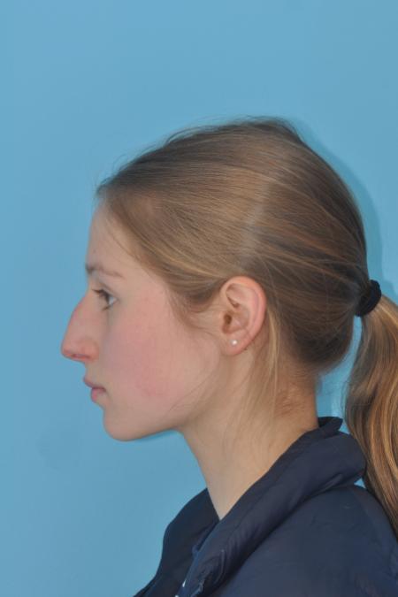 Before image 3 Case #130261 - STRUCTURAL RHINOPLASTY
