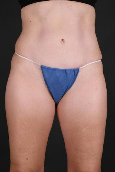 After image 1 Case #130196 - Tummy Tuck