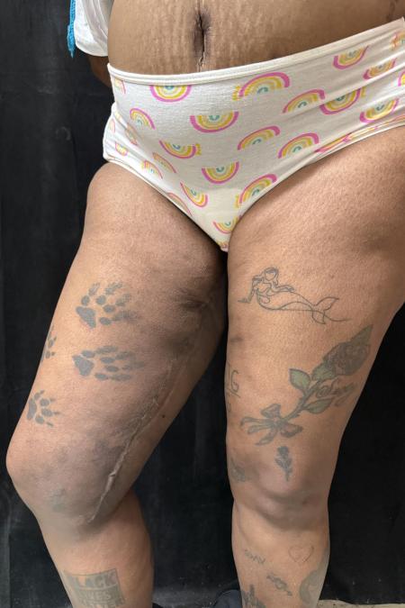 After image 2 Case #130396 - Thigh Lift