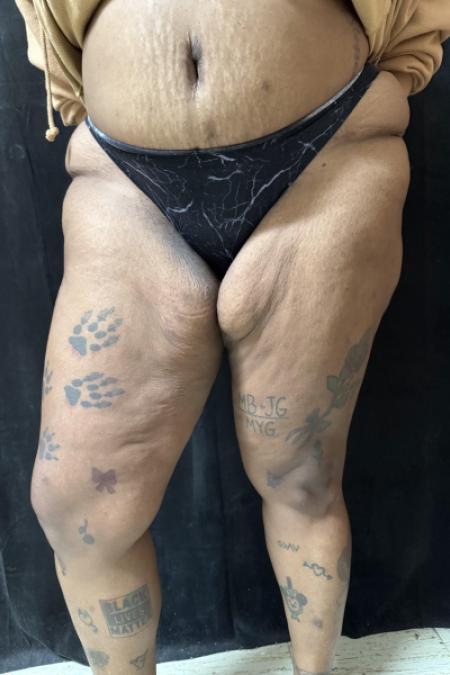 Before image 2 Case #130396 - Thigh Lift