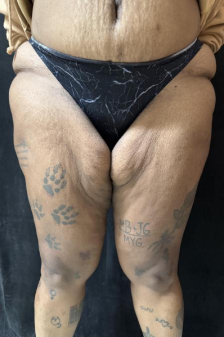 Before image 1 Case #130396 - Thigh Lift