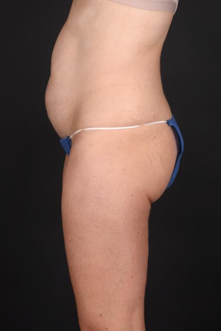 Before image 3 Case #130196 - Tummy Tuck