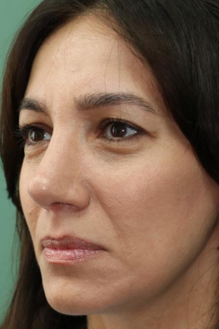 After image 2 Case #130881 - Conventional Septorhinoplasty