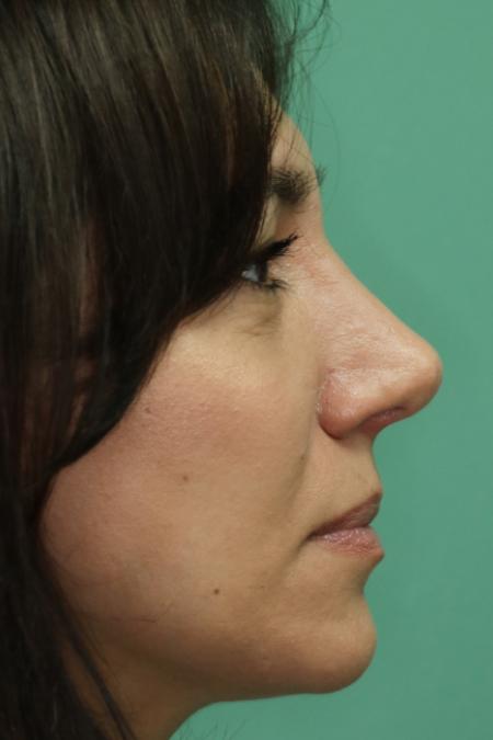 After image 4 Case #130881 - Conventional Septorhinoplasty