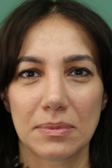 After image 1 Case #130881 - Conventional Septorhinoplasty