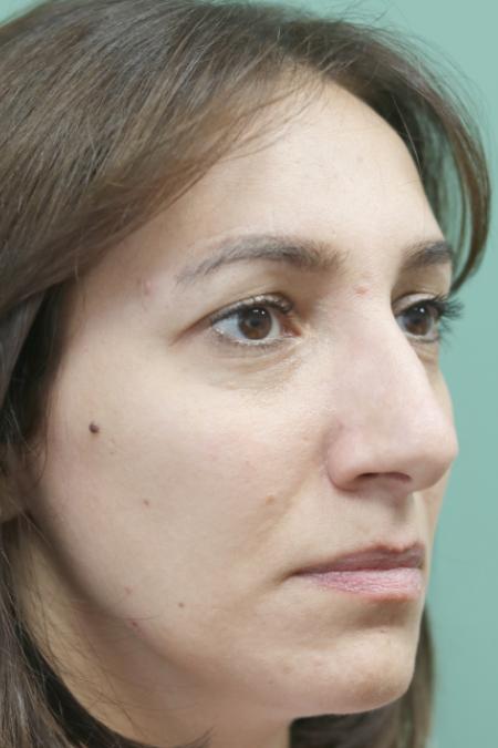 Before image 3 Case #130881 - Conventional Septorhinoplasty