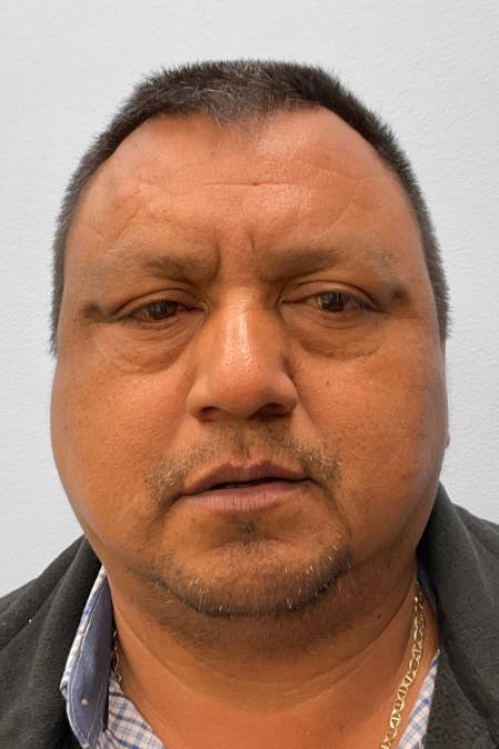Before image 1 Case #132776 - Lower Blepharoplasty