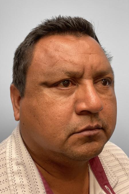 After image 2 Case #132776 - Lower Blepharoplasty