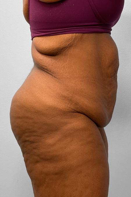 Before image 3 Case #132791 - Tummy Tuck