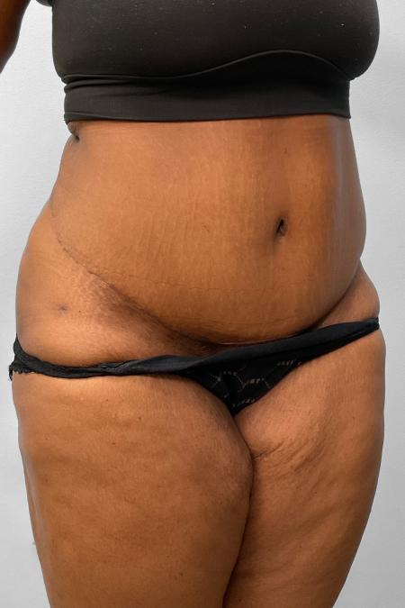 After image 2 Case #132791 - Tummy Tuck