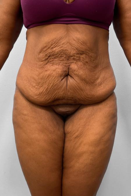 Before image 1 Case #132791 - Tummy Tuck