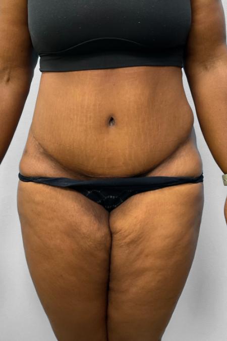 After image 1 Case #132791 - Tummy Tuck