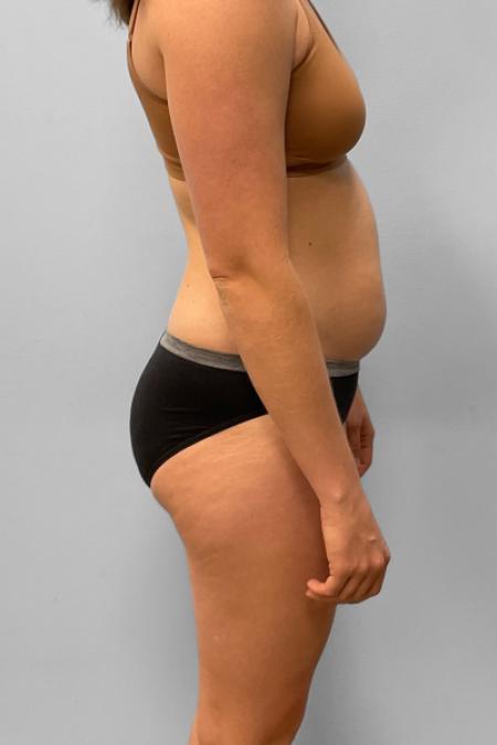 Before image 3 Case #133321 - Tummy Tuck
