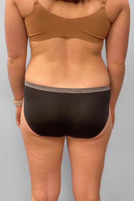 Before image 4 Case #133321 - Tummy Tuck