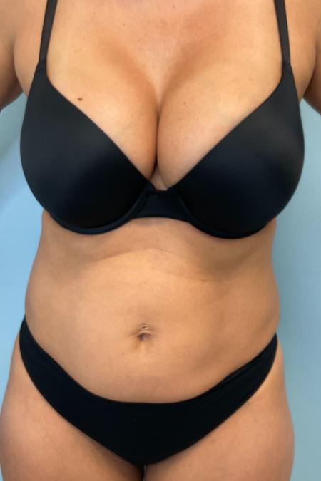 Before image 1 Case #133456 - 48 y.o female w/ Mini Tummy Tuck & Lipo