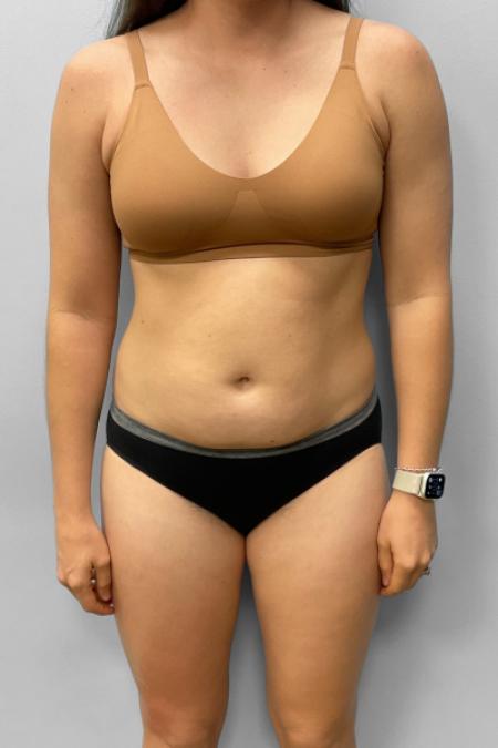Before image 1 Case #133321 - Tummy Tuck