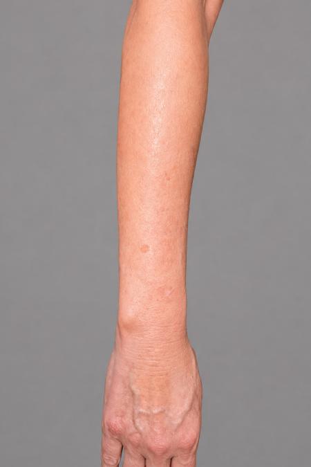 After image 1 Case #133646 - 66 y.o. female with IPL to arms