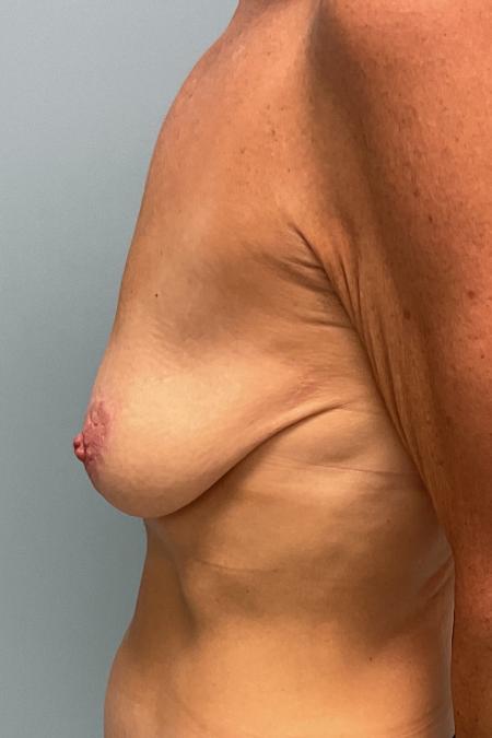 Before image 3 Case #134231 - 64 y.o. female w/ Breast Augmentation 
