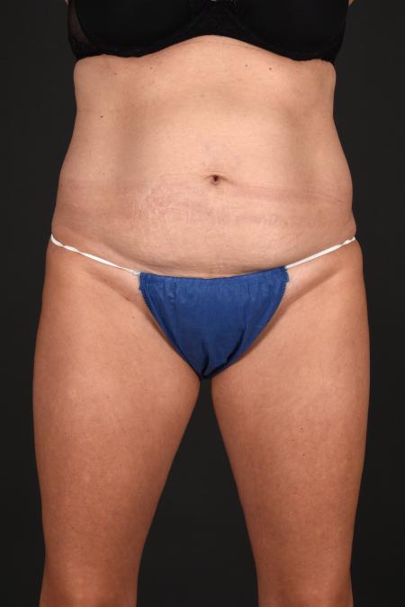 Before image 1 Case #133651 - Abdominoplasty