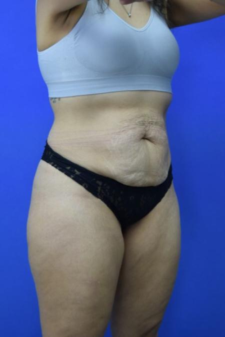 Before image 2 Case #134256 - Drainless Tummy Tuck