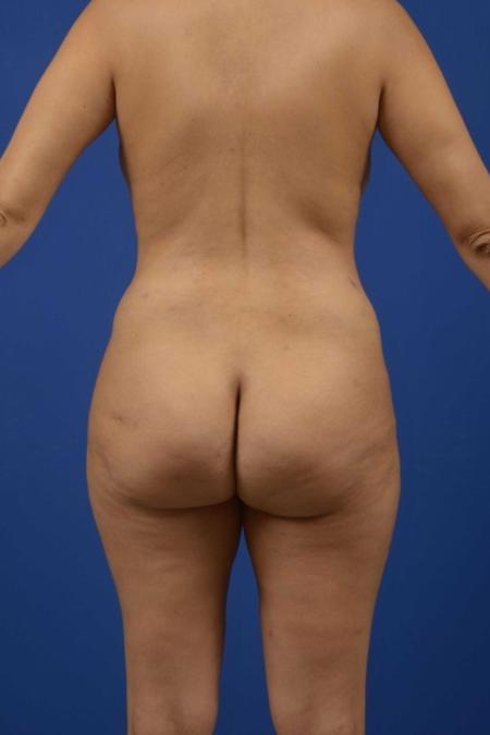 Before image 5 Case #134186 - Abdominoplasty plus Lipoesculpture