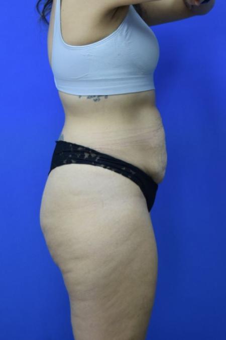 Before image 3 Case #134256 - Drainless Tummy Tuck