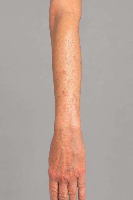 Before image 2 Case #133646 - 66 y.o. female with IPL to arms