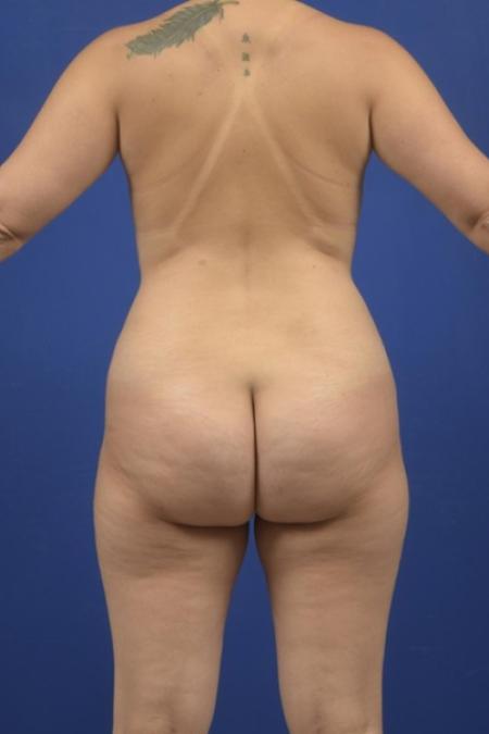 Before image 5 Case #134206 - Abdominoplasty plus Lipoesculpture