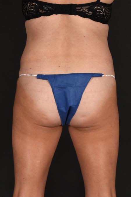 Before image 4 Case #133651 - Abdominoplasty