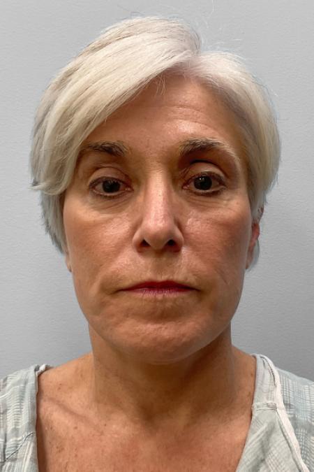 After image 1 Case #134841 - Facial Rejuvenation